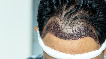 Man head with hair transplant surgery with receding hair line, FUE, Follicular unit extraction,...