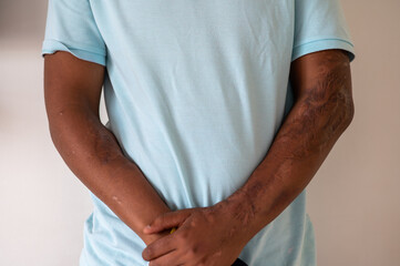 Close up shot of young man with scar on his arms