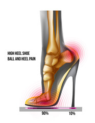 Ball of foot pain high heel shoe bones weight distribution. X ray skeleton realistic anatomy illustration