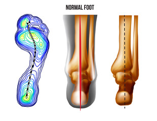 Foot weight distribution. Normal arch foot bottom and back view. No deformation.