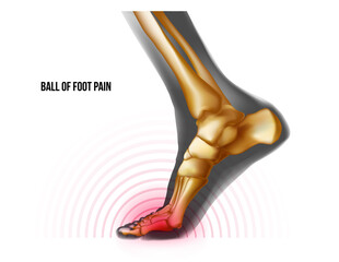 Ball of foot pain bones skeleton realistic anatomy illustration