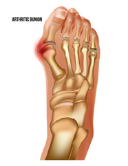 Artritic bunion rheumatoid sore joints, top view.