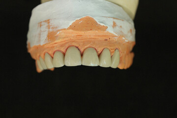 Dentures made of non-precious material and then baked with porcelain before the dentist puts them on the patient.