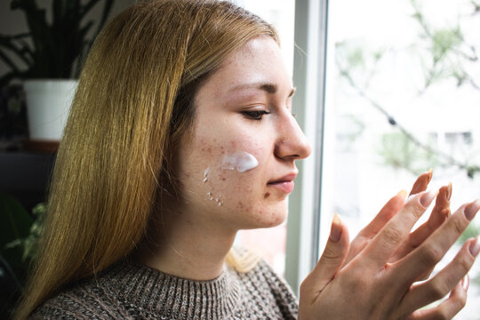 Young Adult caucasian women with acne applying skin lotion