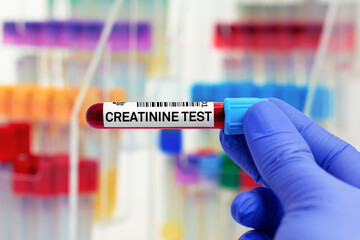 doctor with Blood tube for Creatinine test. Blood sample of patient for Creatinine test in laboratory