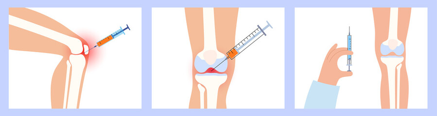 Knee Injection procedure