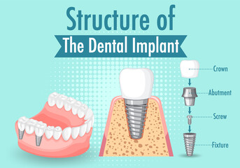 Infographic of human in structure of the dental implant