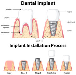 Infographic of human in structure of the dental implant