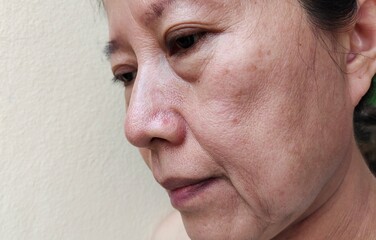 portrait showing flabbiness skin and ptosis beside on the face of the woman, concept health care.