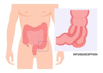 ileus bowel toxic small midgut cecal colon tract Hirschsprung's gastric Ladd band large hiatal hernia cancer tumor swollen crohn's x-ray meckel's twist blocked birth defect infant children pain short