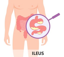 ileus bowel toxic small midgut cecal colon tract Hirschsprung's gastric Ladd band large hiatal hernia cancer tumor swollen crohn's x-ray meckel's twist blocked birth defect infant children pain short