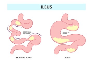 ileus bowel toxic small midgut cecal colon tract Hirschsprung's gastric Ladd band large hiatal hernia cancer tumor swollen crohn's x-ray meckel's twist blocked birth defect infant children pain short