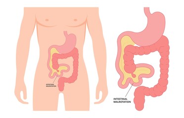 ileus bowel toxic small midgut cecal colon tract Hirschsprung's gastric Ladd band large hiatal hernia cancer tumor swollen crohn's x-ray meckel's twist blocked birth defect infant children pain short