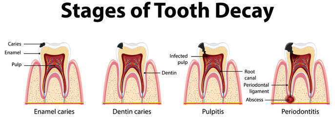 Infographic of human in the stages of tooth decay