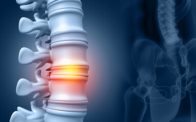 Lumbar intervertebral spine hernia. 3d illustration - obrazy, fototapety, plakaty