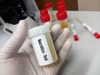Urine drug screen sample for Narcotics urine test , also known as a urine drug screening painless...