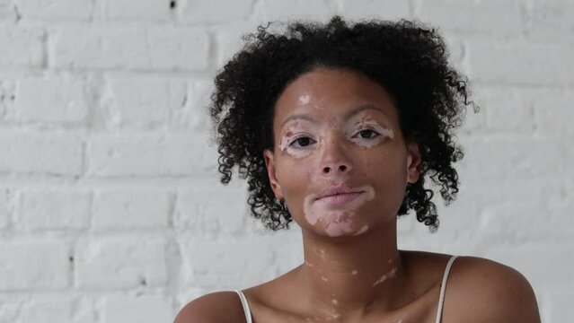 Confident afro woman with vitiligo looking at camera
