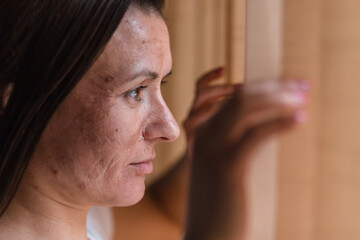 Obraz premium Close up photo of woman with dry skin looking in the window.