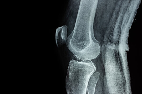 Film X-ray of a leg bone person