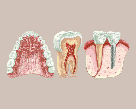 113_ Jaw, Teeth, Gums, Palate_dental Implant_tooth Structure, Graphics_jaw, Teeth, Gums, Sky, Graphics, Isolated Vector Drawing, Anatomical, Detailed Sketch, Set, Colored, Tooth, Dental Implant, Color