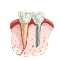 106_dental implant_dentistry. part of gum, healthy tooth and dental implant, dental poster