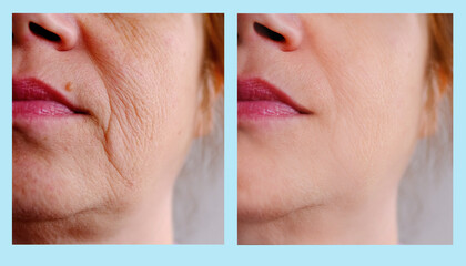 close-up part of female face of woman 40-50 years old with age wrinkles, facial wrinkles before and...