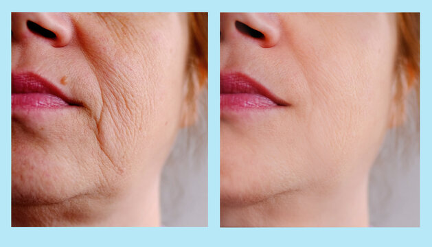 close-up part of female face of woman 40-50 years old with age wrinkles, facial wrinkles before and after treatment, concept of cosmetics, skincare, correction surgery, flyer for your ad antiaging