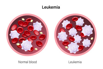 Leukemia. The difference of blood leukemia and normal blood. Red blood cells, White blood cells and platelets.