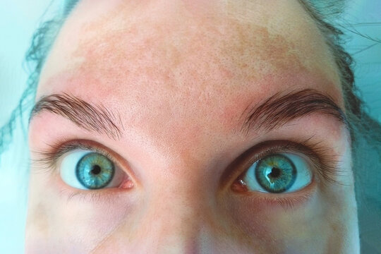 Spot melasma pigmentation facial treatment on face woman. Problem skincare and health concept. Young woman with pigmented skin.