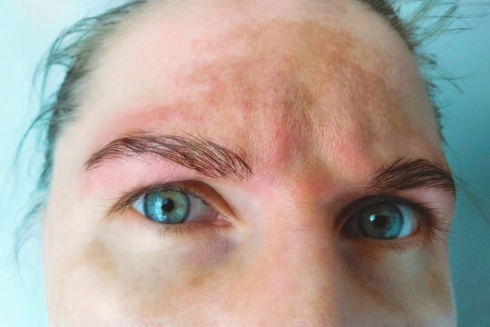Spot melasma pigmentation facial treatment on face woman. Problem skincare and health concept. Young woman with pigmented skin.