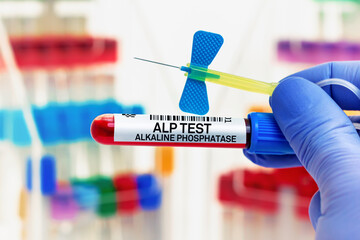 doctor with Blood tube for Alkaline Phosphatase ALP test in lab. Blood sample of patient for ALP...
