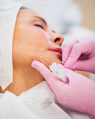 Thread lifting of the face is a minimally invasive mesotherapeutic procedure - the doctor makes a...