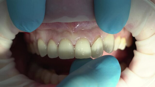 fitting of ceramic veneers on the teeth of the upper jaw