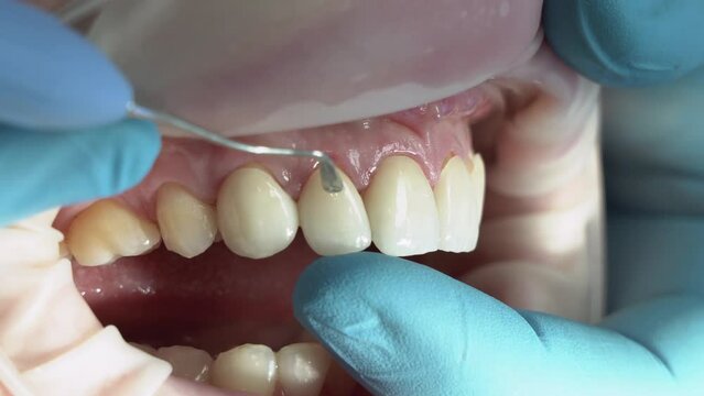 porcelain veneers on central teeth side view