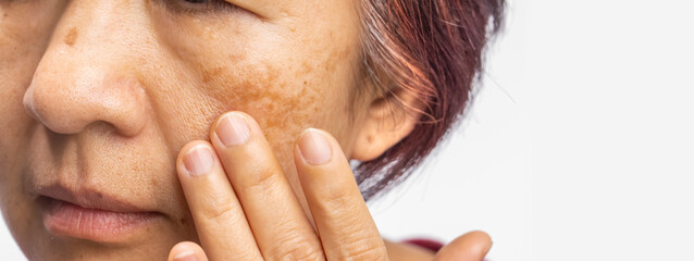 Menopausal women worry about melasma on face.