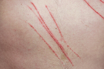 Deep scratches from claws on the skin of a person.