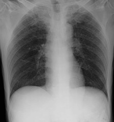 chest x-ray image of miliary nodules 