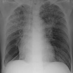 chest x-ray image of miliary nodules 