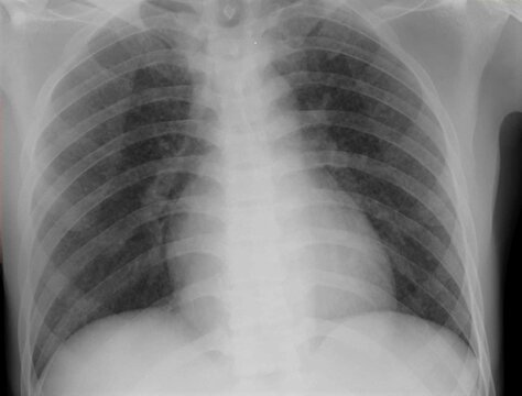 chest x-ray image of miliary nodules 