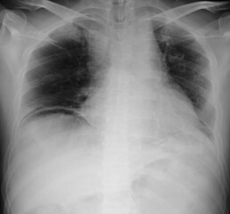 Chest x ray image  of pneumoperitoneum ,free air on  abdomen as luscent cresent lesion sub diafragma