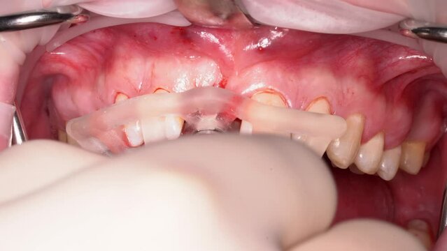 the surgeon removes the implant driver and removes the surgical guide