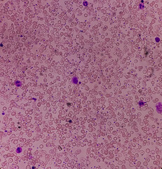 Hereditary hemolytic anemia with thrombocytosis, inherited blood disorder also called intrinsic hemolytic anemia,G6PD deficiency, focus view.
