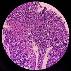 Cancer of the antrum, incisura of stomach, adenocarcinoma of stomach, show gastric mucosa, malignant neoplasm, microscopic 40x view.