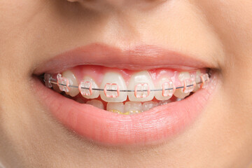 Teeth of young woman with dental braces, closeup