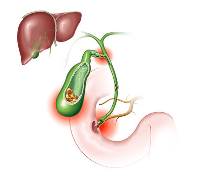 Gallstone disease. gallstones blocking bile duct and pancreatic duct. Labeled Illustration