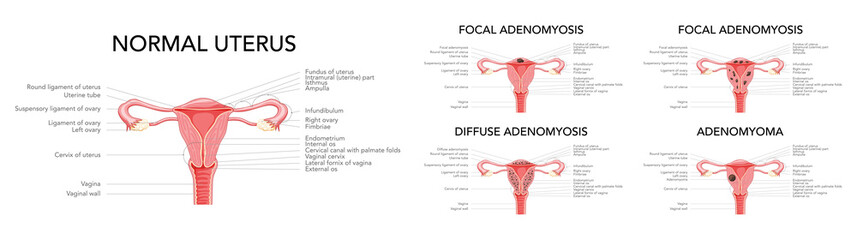 Adenomyosis illness set - focal, diffuse, adenomyoma and normal uterus with inscriptions. Structure of Human anatomy Female reproductive Sick system organs in Latin text. Vector illustration isolated - obrazy, fototapety, plakaty