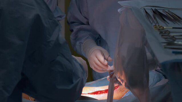 Closeup of doctors hands operating a patient conducting open cut surgery in surgical room. Healthcare and medical intervention concept