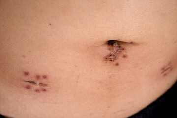 Surgical incisions wound by endoscopic method