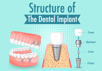 Infographic of human in structure of the dental implant