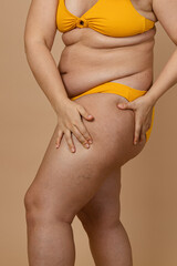 Cropped photo of woman body excess orange skin in yellow underwear, treatment of obesity cellulite...